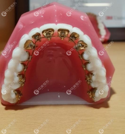3M公司的Incognito舌侧矫治器