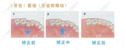 牙齿矫正前后对比