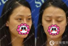 网红自爆两年前做的双眼皮消失在杭州艺星修复高清过程图
