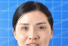 短短1小时 30+的我在重庆爱思特埋线4根看着年轻了10岁