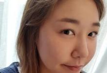 挖到李真秀smart双鄂案例 直面听整容者怎么评价菲斯莱茵