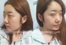 做鼻子再手术+面部不对称整形后 她力破韩国ID不靠谱传言