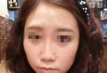 有失少女感的高颧骨经过朴原辰做颧骨内推术变V脸小可爱