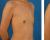乳房整形综合资料分享已经案例对比