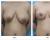 乳房整形综合资料分享已经案例对比