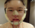 我的美丽蜕变分享腮削骨 隆鼻子 双眼皮 自体脂肪丰额头