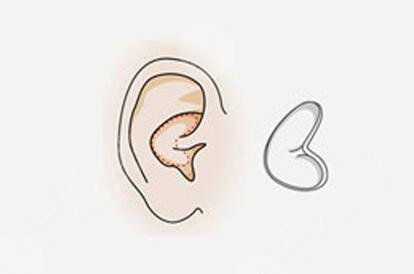 耳软骨鼻子可以维持多久