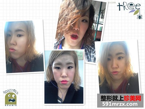 两鄂整形+眼型矫正术前后效果对比图和恢复过程