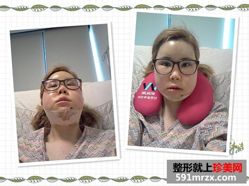 两鄂整形+眼型矫正术前后效果对比图和恢复过程