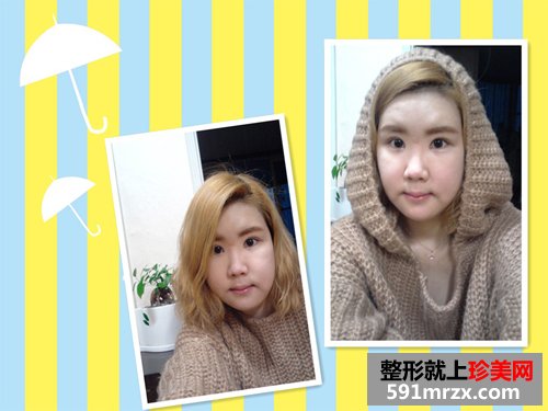两鄂整形+眼型矫正术前后效果对比图和恢复过程