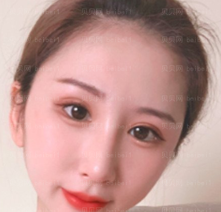 西京医院整形科樊星医师光子嫩肤介绍片较新分享_脸部没有那么暗淡了,皮肤也细腻光滑了~