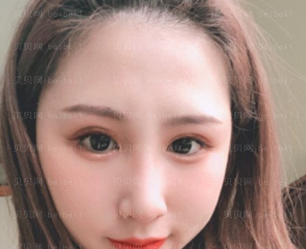 西京医院整形科樊星医师光子嫩肤介绍片较新分享_脸部没有那么暗淡了,皮肤也细腻光滑了~