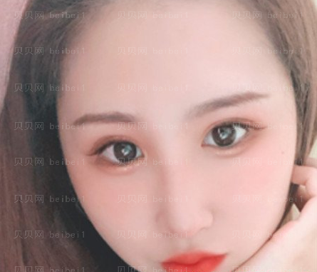 西京医院整形科樊星医师光子嫩肤介绍片较新分享_脸部没有那么暗淡了,皮肤也细腻光滑了~