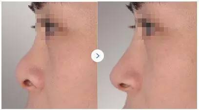 影响隆鼻的*因素有哪些?尽美整形网