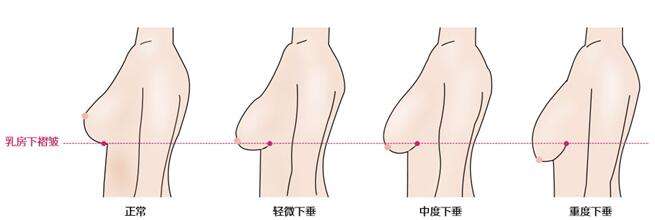 乳房下垂矫正手术真的有*果吗?