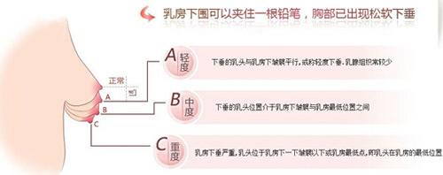 乳房下垂矫正后会再松弛吗?