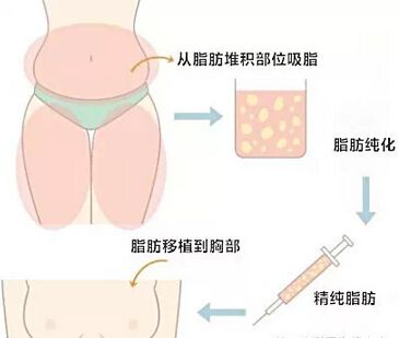 自体脂肪移植隆胸后的手感好吗?