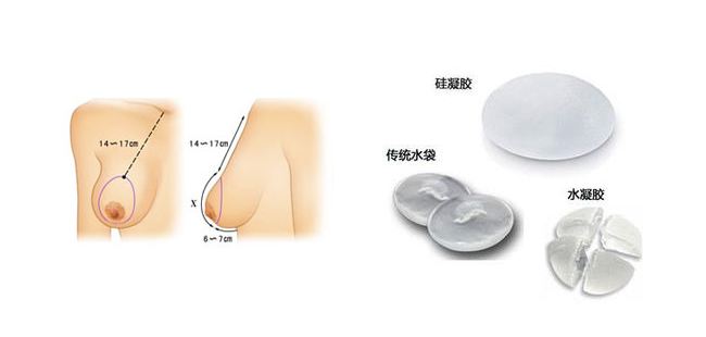 假体隆胸需要多少钱?价格贵不贵?