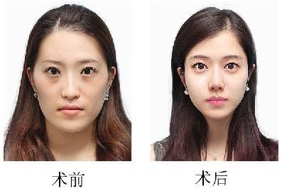 成都哪些医院、医生可以做颧骨内推?