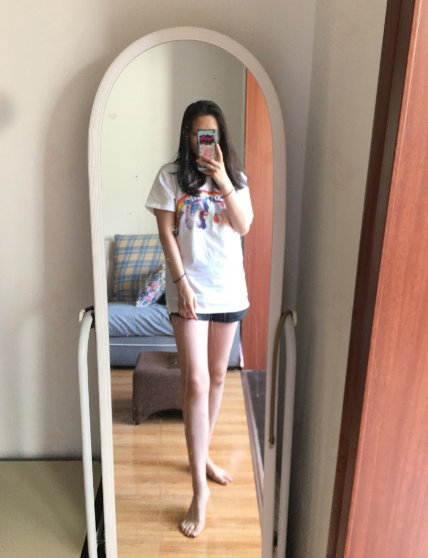 乌鲁木齐大腿吸脂80多天,小姐姐说的*果很满意