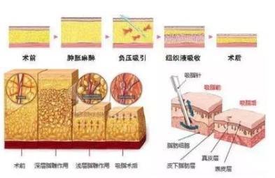 吸脂会让皮肤松弛吗?