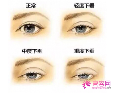 你想做双眼皮吗?埋线双眼皮手术果自然吗?小编给你科普科普埋线双眼皮知识!
