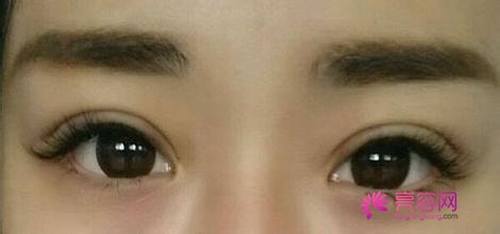 你想做双眼皮吗?埋线双眼皮手术果自然吗?小编给你科普科普埋线双眼皮知识!