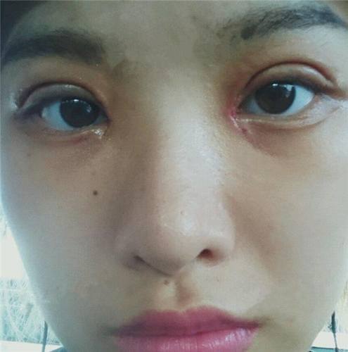 给你们看看我的双眼皮案例,真的变得好漂亮啦!!!不看后悔呦