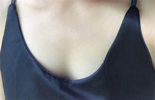 北京叶子李明隆胸怎么样?案例_价格_口碑