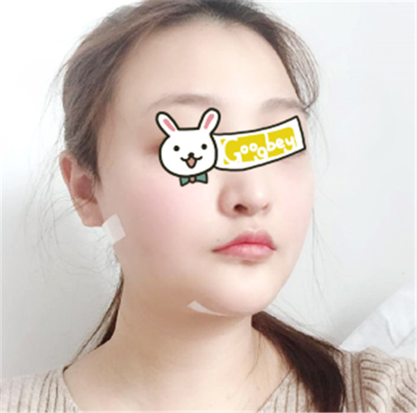 上海安缦严彪抽脂术后果怎么样?案例,价格,口碑