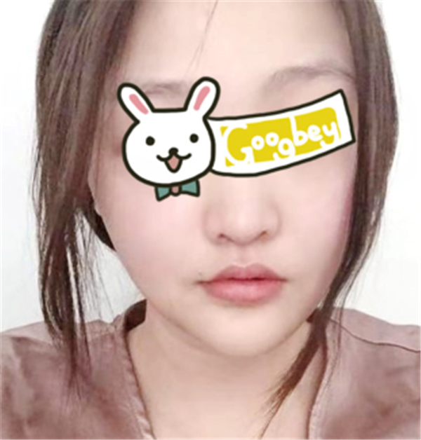 上海安缦严彪抽脂术后果怎么样?案例,价格,口碑