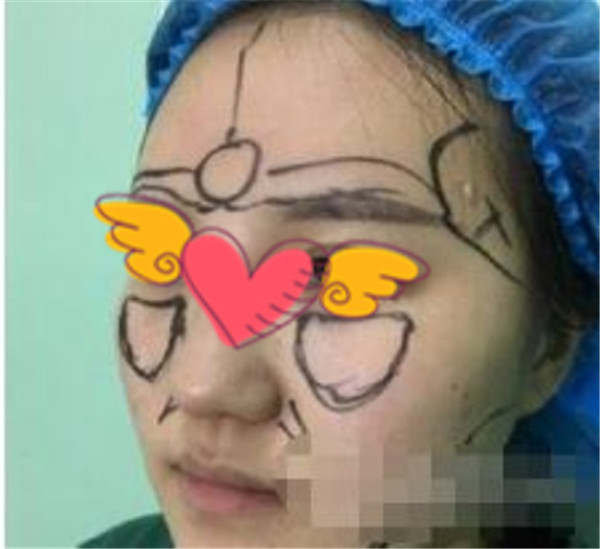 北京上上相郑楚蓉抽脂术后果怎么样?案例,价格,口碑