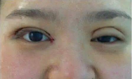 双眼皮做出了错误的选择，眼睛变成这样