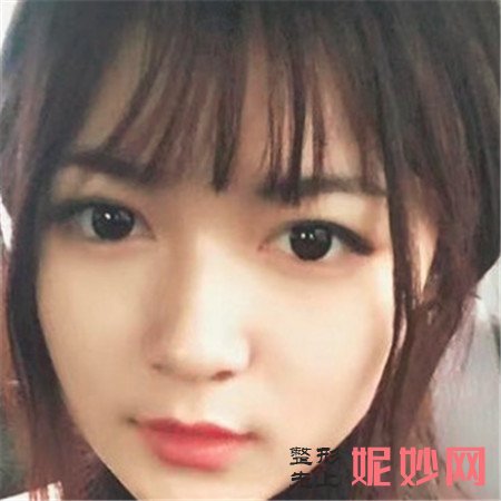 到湘雅三医院烧伤整形外科找尹朝奇做的埋线提升，术后满满少女感